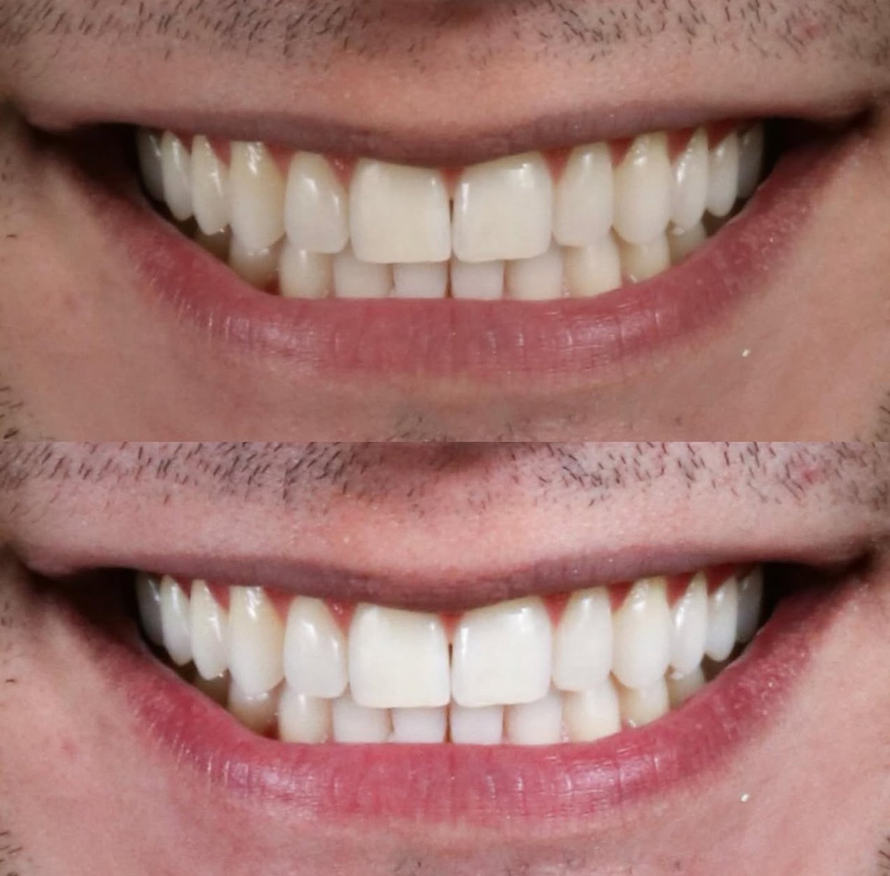 Blanqueamiento domiciliario